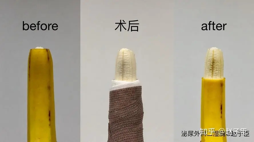 中山割包皮,中山割包皮医院,中山割包皮哪个医院好